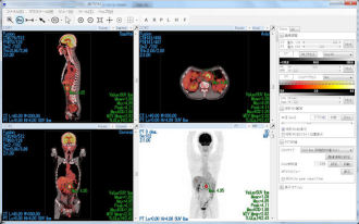 PETSTATの操作画面。全身のPET/CT融合画像を多断面で表示
